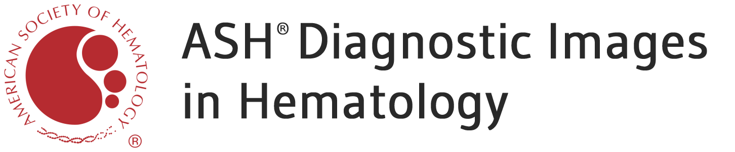 ASH Diagnostic Images in Hematology